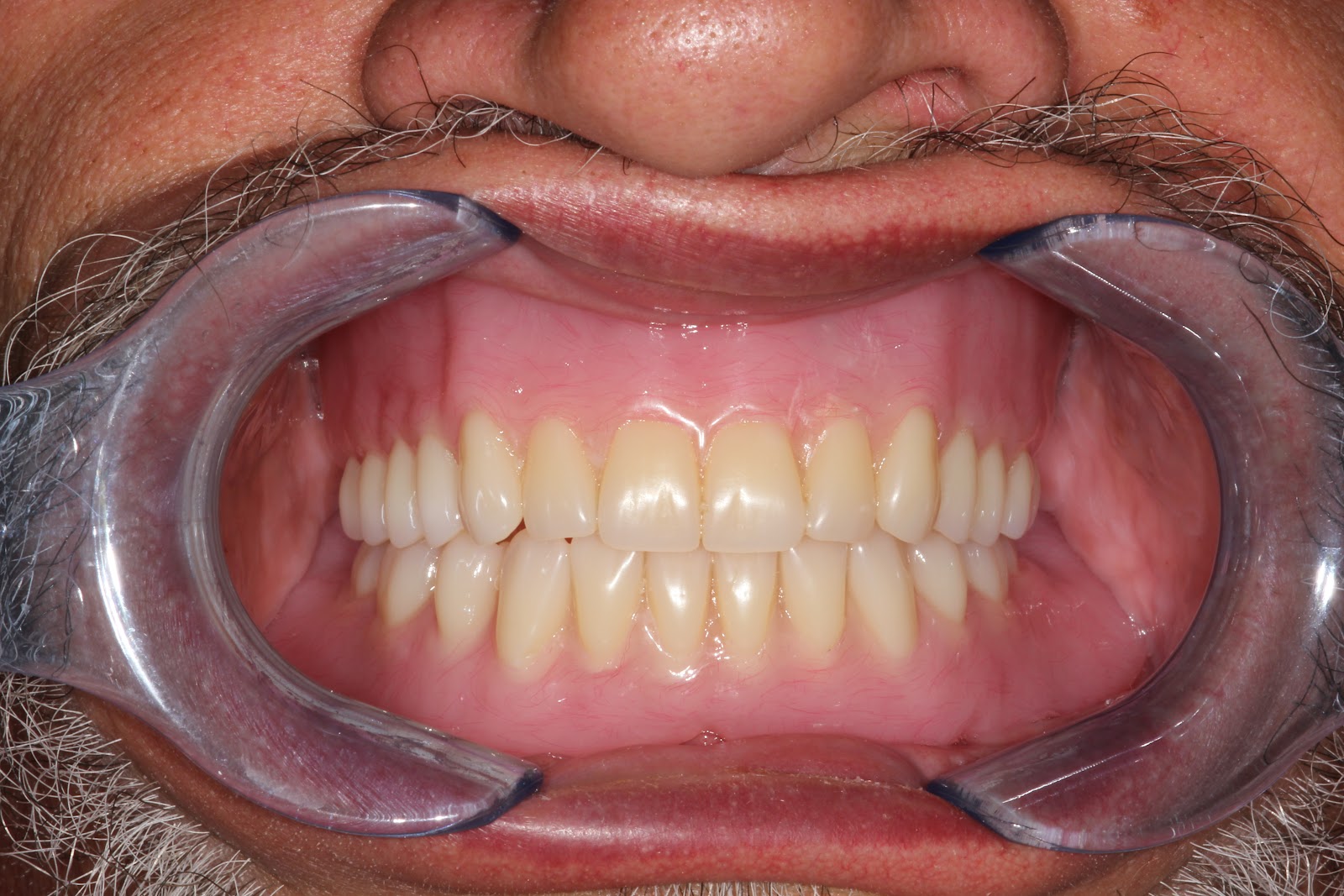 denture delivery Boise Idaho Prosthodontics: Maxillary Complete Denture / Mandibular ... denture delivery Boise Idaho Prosthodontics: Maxillary Complete Denture / Mandibular ...
